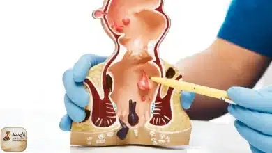 علاج البواسير